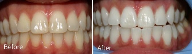 Before and after treatment with crowns